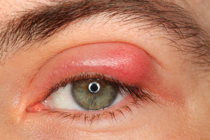 Stye | Signs and Symptoms of Styes | Ashbaker Vision Clinic Vancouver